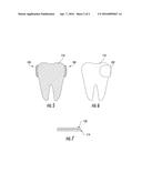 Coating for a Dental Matrix Band diagram and image