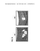 STENTS HAVING CONTROLLED ELUTION diagram and image