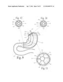 Colonnade (TM) Expandable Intragastric Food Flow Lumen Device diagram and image