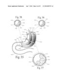 Colonnade (TM) Expandable Intragastric Food Flow Lumen Device diagram and image