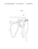 Anti-Extravasation Surgical Portal Plug diagram and image