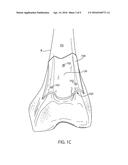 PATIENT-SPECIFIC GUIDES TO IMPROVE POINT REGISTRATION ACCURACY IN SURGICAL     NAVIGATION diagram and image