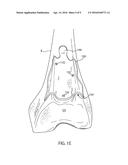 PATIENT-SPECIFIC GUIDES TO IMPROVE POINT REGISTRATION ACCURACY IN SURGICAL     NAVIGATION diagram and image