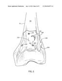 PATIENT-SPECIFIC GUIDES TO IMPROVE POINT REGISTRATION ACCURACY IN SURGICAL     NAVIGATION diagram and image