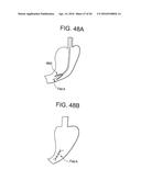 Devices and Methods for Endoluminal Plication diagram and image