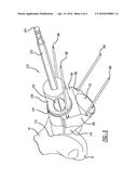 Patello-Femoral With Reusable Instruments diagram and image