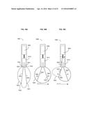 Systems and Devices for Cutting Tissue diagram and image