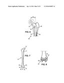 METHOD FOR DESIGNING A PATIENT SPECIFIC ORTHOPAEDIC DEVICE diagram and image