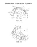 MOLDED DENTURE AND METHOD AND APPARATUS OF MAKING SAME diagram and image