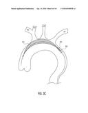 CATHETER-BASED APPARATUSES AND METHODS diagram and image