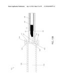 CANNULA INGRESS SYSTEM diagram and image