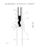 CANNULA INGRESS SYSTEM diagram and image