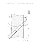 MEDICAL GUIDE ELEMENT WITH DIAMETER TRANSITION diagram and image