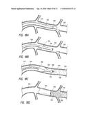 CATHETER-ASSISTED TUMOR TREATMENT diagram and image