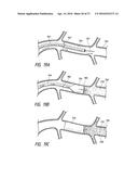 CATHETER-ASSISTED TUMOR TREATMENT diagram and image