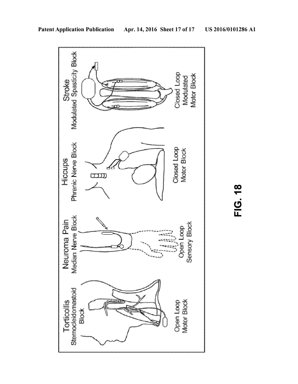 METHODS OF TREATMENT OF A NEUROLOGICAL DISORDER USING ELECTRICAL NERVE     CONDUCTION BLOCK - diagram, schematic, and image 18