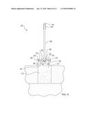 Ice Depresser Device diagram and image