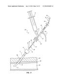 BIORESORBABLE DETACHABLE TIP DESIGN FOR ADHESIVE-BASED EXTRAVASCULAR     CLOSURE DEVICE diagram and image