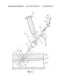 BIORESORBABLE DETACHABLE TIP DESIGN FOR ADHESIVE-BASED EXTRAVASCULAR     CLOSURE DEVICE diagram and image