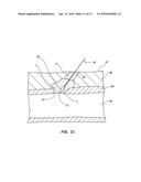 BIORESORBABLE DETACHABLE TIP DESIGN FOR ADHESIVE-BASED EXTRAVASCULAR     CLOSURE DEVICE diagram and image