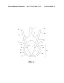 Systems and Methods for Performing Spinal Surgery diagram and image