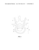 Systems and Methods for Performing Spinal Surgery diagram and image