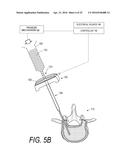 BONE TREATMENT SYSTEMS AND METHODS diagram and image