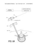 BONE TREATMENT SYSTEMS AND METHODS diagram and image