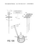 BONE TREATMENT SYSTEMS AND METHODS diagram and image