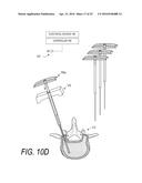 BONE TREATMENT SYSTEMS AND METHODS diagram and image