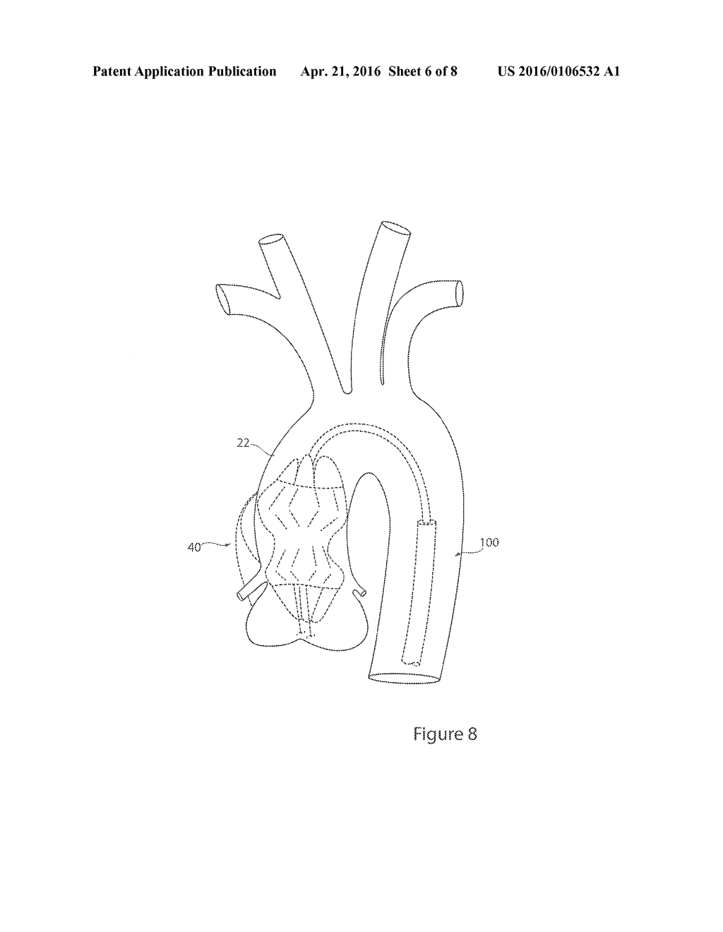 STENT GRAFT AND INTRODUCER ASSEMBLY - diagram, schematic, and image 07