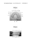 STENT diagram and image