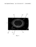 LASER EYE SURGERY LENS FRAGMENTATION diagram and image