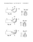 Devices and Methods Useable for Treatment of Glaucoma and Other Surgical     Prcedures diagram and image