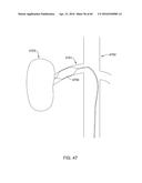 METHODS AND APPARATUSES FOR REMODELING TISSUE OF OR ADJACENT TO A BODY     PASSAGE diagram and image