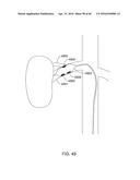 METHODS AND APPARATUSES FOR REMODELING TISSUE OF OR ADJACENT TO A BODY     PASSAGE diagram and image