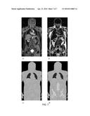 CORTICAL BONE SEGMENTATION FROM MR DIXON DATA diagram and image