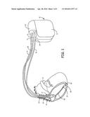 ATRIAL ARRHYTHMIA EPISODE DETECTION IN A CARDIAC MEDICAL DEVICE diagram and image