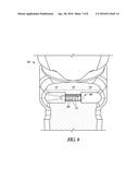 IMPLANT WITH SUTURE ANCHOR FIXATION CAPABILITY diagram and image