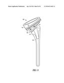 IMPLANT WITH SUTURE ANCHOR FIXATION CAPABILITY diagram and image