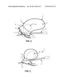 METHOD OF AMPUTATING AND MORCELLATING A UTERUS diagram and image