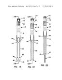 Bone fixation system diagram and image