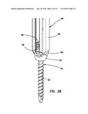 Bone fixation system diagram and image