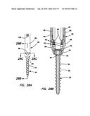 Bone fixation system diagram and image