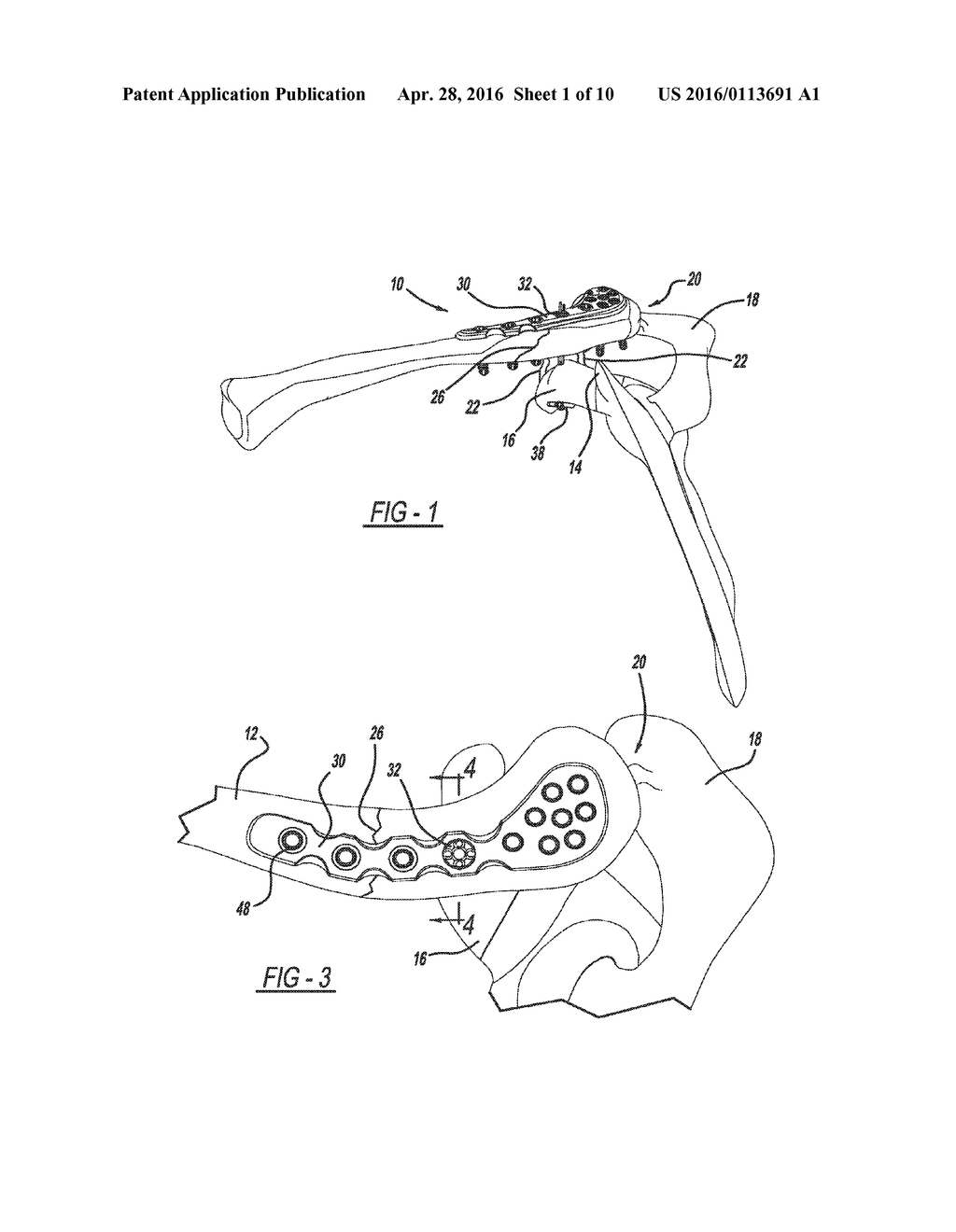 METHOD OF IMPLANTING A BONE FIXATION ASSEMBLY - diagram, schematic, and image 02