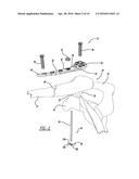 METHOD OF IMPLANTING A BONE FIXATION ASSEMBLY diagram and image