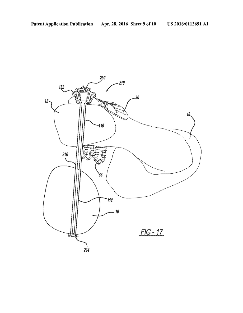 METHOD OF IMPLANTING A BONE FIXATION ASSEMBLY - diagram, schematic, and image 10