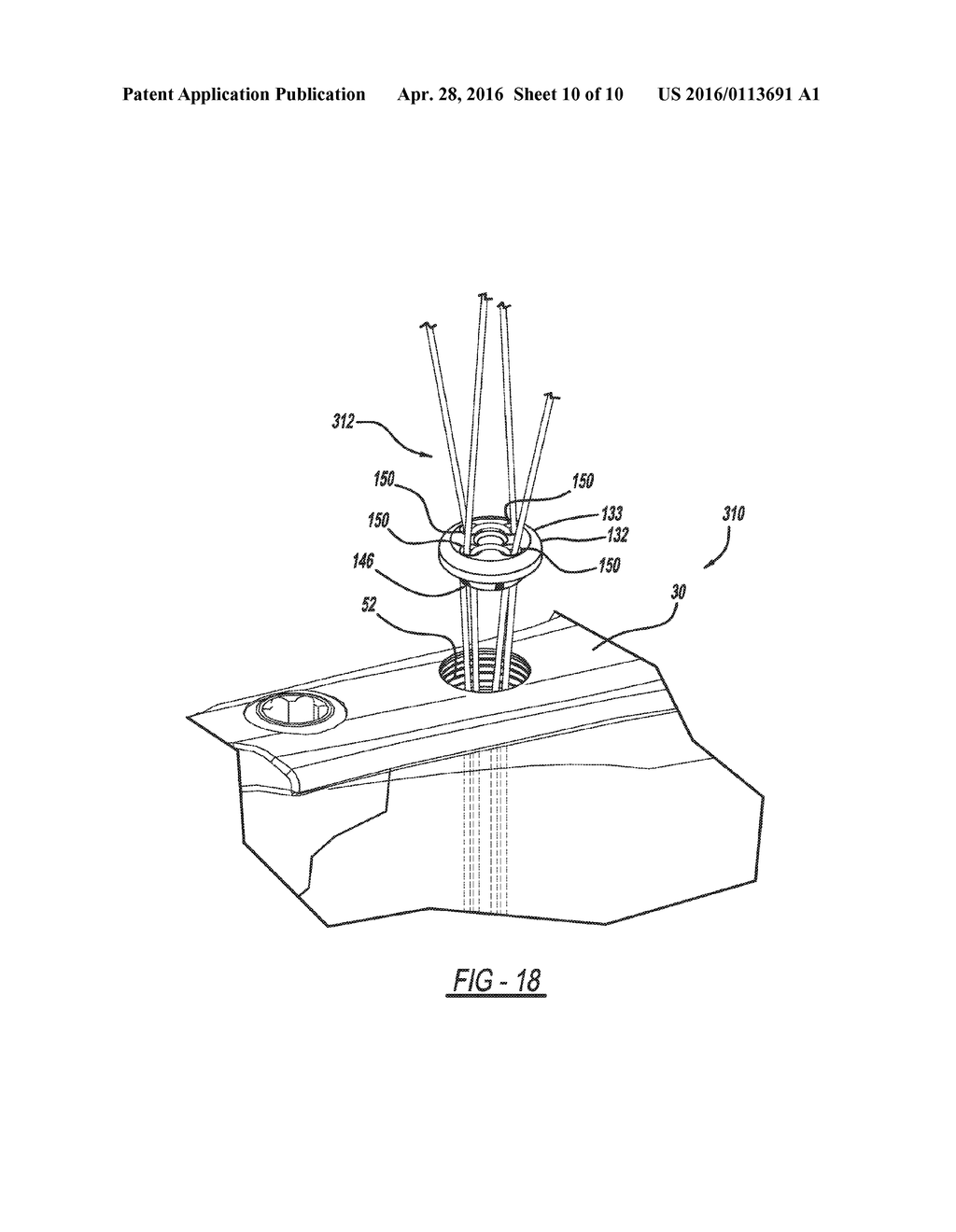 METHOD OF IMPLANTING A BONE FIXATION ASSEMBLY - diagram, schematic, and image 11