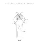 BONE FRACTURE REDUCTION DEVICE AND METHODS FOR USING SAME diagram and image