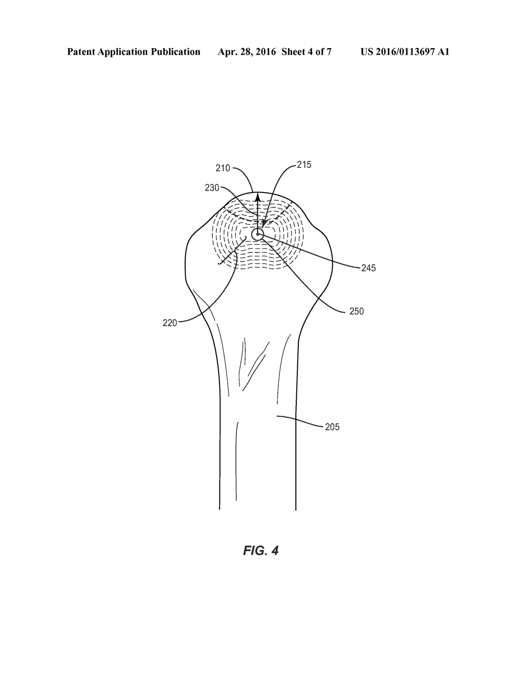 BONE FRACTURE REDUCTION DEVICE AND METHODS FOR USING SAME - diagram, schematic, and image 05